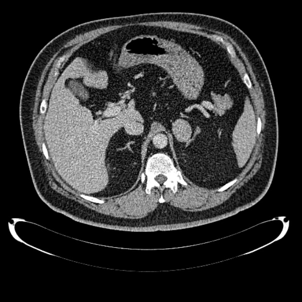 Bosniak renal cyst - type IV (Radiopaedia 24244-24518 C 81).jpg