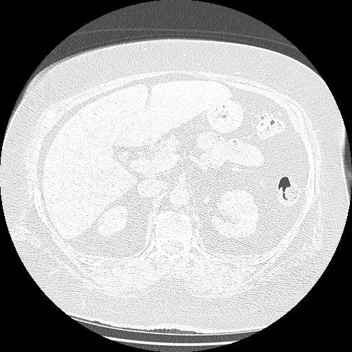 Bovine aortic arch - right internal mammary vein drains into the superior vena cava (Radiopaedia 63296-71875 Axial lung window 200).jpg