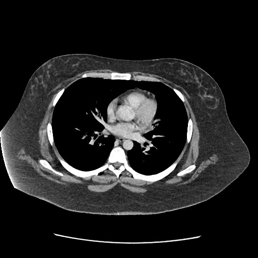 File:Bowel and splenic infarcts in acute lymphocytic leukemia (Radiopaedia 61055-68915 A 4).jpg