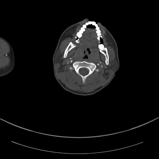 Brachiocephalic trunk pseudoaneurysm (Radiopaedia 70978-81191 Axial bone window 4).jpg