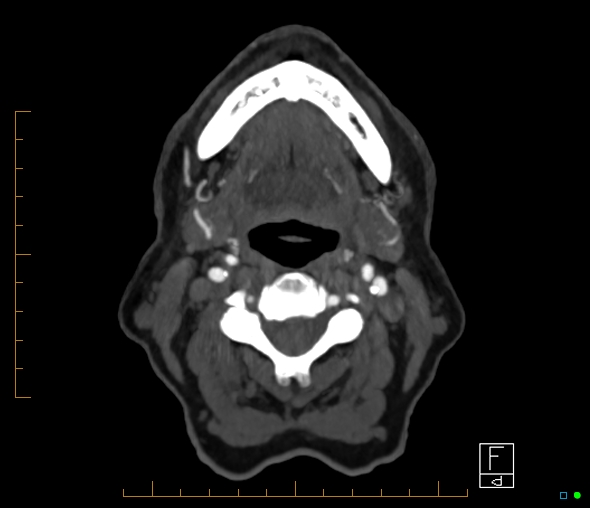 Brachiocephalic trunk stenosis (Radiopaedia 87242-103519 A 88).jpg