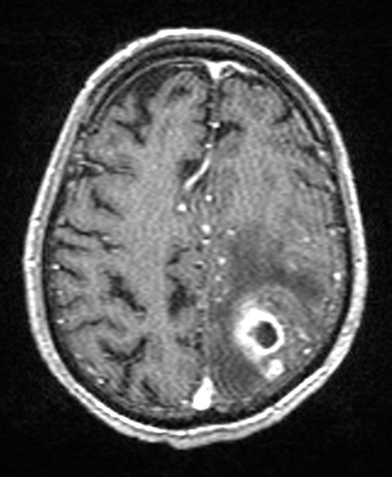Brain abscess with dual rim sign (Radiopaedia 87566-103938 Axial T1 C+ 119).jpg