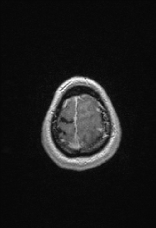 Brain abscess with ventriculitis (Radiopaedia 85703-101495 Axial T1 C+ 155).jpg
