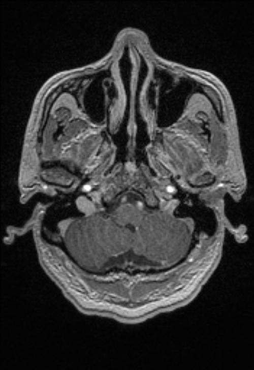 Brain abscess with ventriculitis (Radiopaedia 85703-101495 Axial T1 C+ 34).jpg