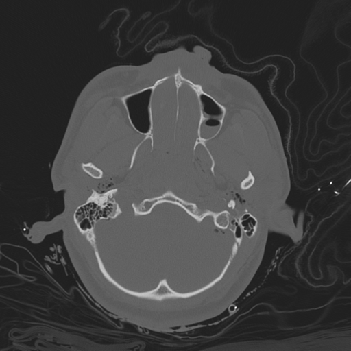 Brain contusions, internal carotid artery dissection and base of skull fracture (Radiopaedia 34089-35339 Axial bone window 46).png