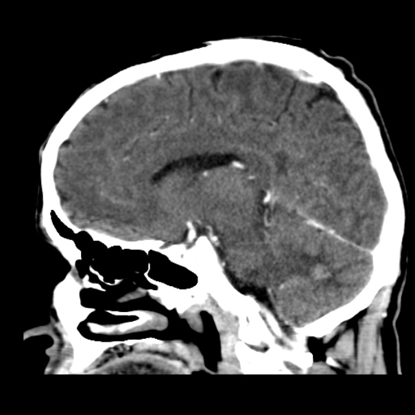 Brain metastases from lung cancer (Radiopaedia 24480-24781 C+ delayed 26).jpg