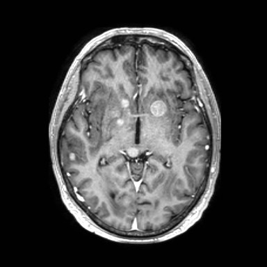 Brain metastases from lung cancer (Radiopaedia 83839-99028 Axial T1 C+ 29).jpg