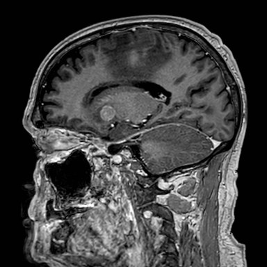 Brain metastases from lung cancer (Radiopaedia 83839-99028 Sagittal T1 C+ 40).jpg