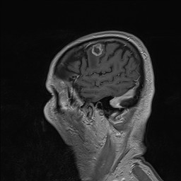 Brain metastasis (Radiopaedia 42617-45761 Sagittal T1 C+ 16).jpg
