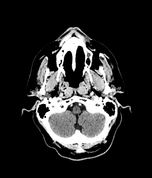 Brain metastasis (large cystic mass) (Radiopaedia 47497-52106 Axial C+ 13).png