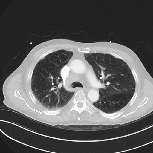 Brain metastasis (lung cancer) (Radiopaedia 48289-53180 Axial lung window 24).png