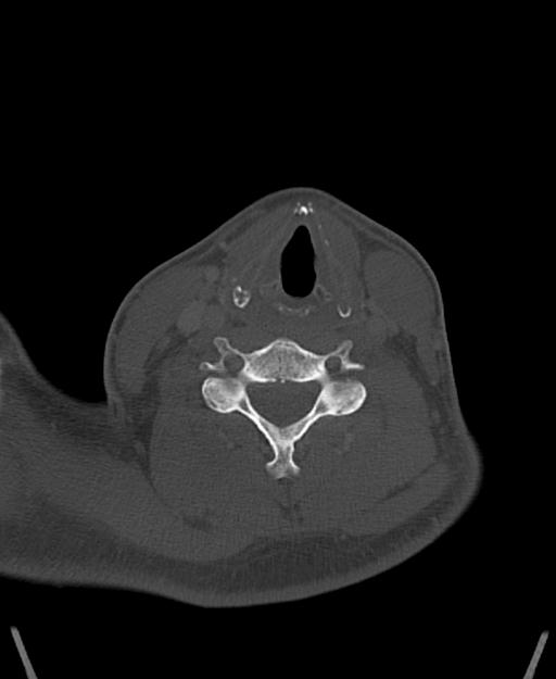 Branchial cleft cyst (Radiopaedia 31167-31875 Axial bone window 47).jpg