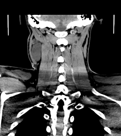 Branchial cleft cyst (Radiopaedia 31167-31875 Coronal C+ delayed 48).jpg