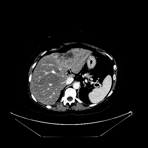 Breast cancer pseudocirrhosis with lobar invovlement (Radiopaedia 81080-94670 Axial liver window 46).jpg