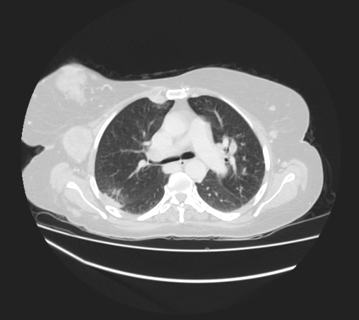 Breast metastases from facial malignant melanoma (Radiopaedia 60316-67975 Axial lung window 41).jpg