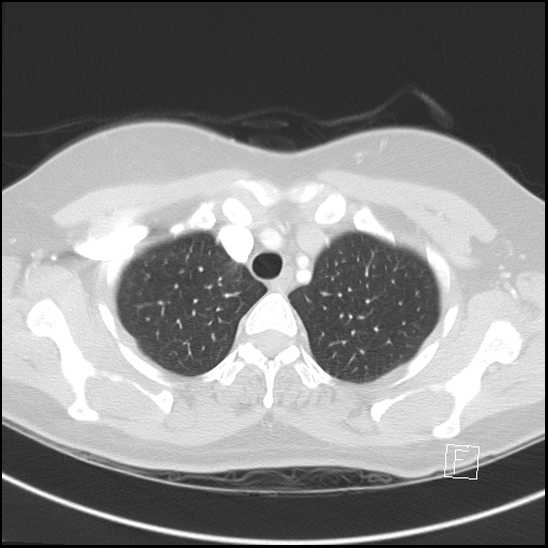 File:Breast metastases from renal cell cancer (Radiopaedia 79220-92225 Axial lung window 14).jpg