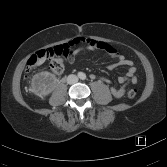 Breast metastases from renal cell cancer (Radiopaedia 79220-92225 C 62).jpg