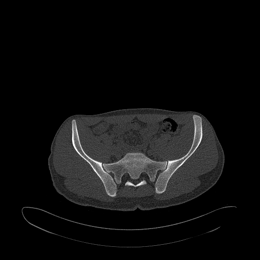 Brodie abscess- femoral neck (Radiopaedia 53862-59966 Axial bone window 46).jpg
