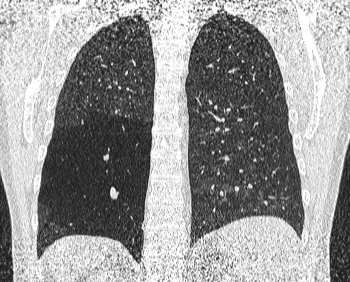 Bronchial atresia (Radiopaedia 58271-65417 Coronal lung window 43).jpg