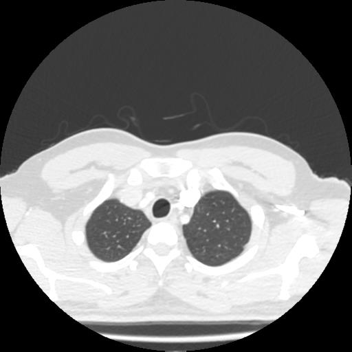 Bronchial carcinoid (Radiopaedia 80013-93291 Axial lung window 3).jpg