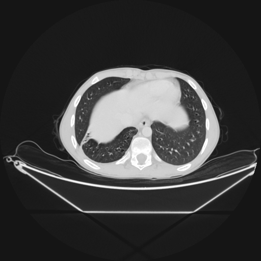 Bronchial carcinoid tumor (Radiopaedia 57187-64090 Axial lung window 64).jpg
