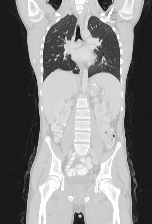 Bronchial carcinoid tumor (Radiopaedia 57187-64090 Coronal lung window 51).jpg