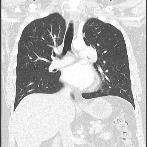 Bronchial carcinoid tumor (Radiopaedia 67377-76764 Coronal lung window 37).jpg