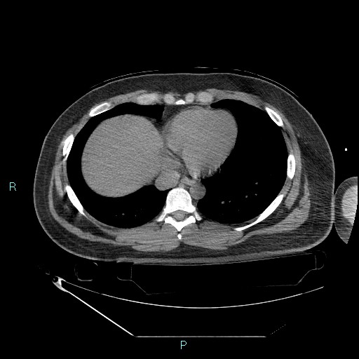 Bronchial carcinoid tumor (Radiopaedia 78272-90870 Axial non-contrast 77).jpg