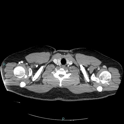 Bronchial carcinoid tumor (Radiopaedia 78272-90875 A 8).jpg