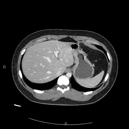 Bronchial carcinoid tumor (Radiopaedia 78272-90875 A 87).jpg
