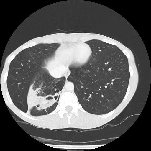 Bronchial carcinoid tumor causing right lower lobe collapse (Radiopaedia 83495-98594 Axial lung window 42).jpg