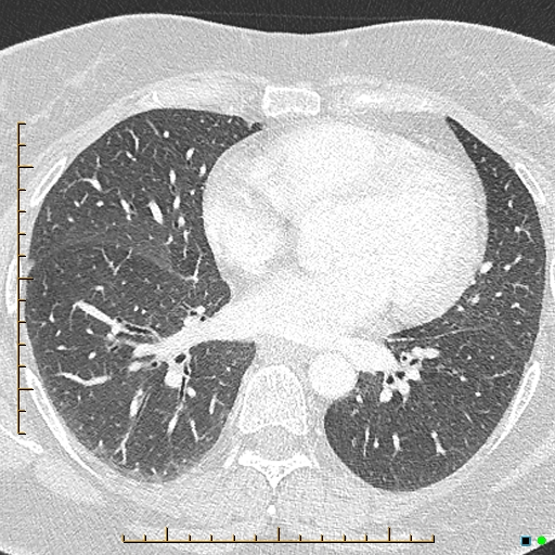 File:Bronchial diverticula (Radiopaedia 79512-92676 Axial lung window 118).jpg