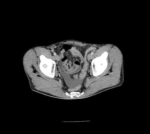 File:Bronchiectasis in Crohn disease (Radiopaedia 60311-67977 B 161).jpg