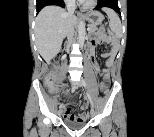 Bronchiectasis in Crohn disease (Radiopaedia 60311-67977 C 39).jpg