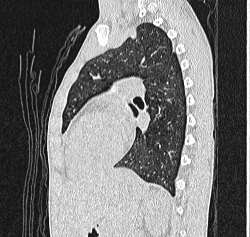 File:Bronchiolitis obliterans (Radiopaedia 71538-81897 Sagittal lung window 43).jpg