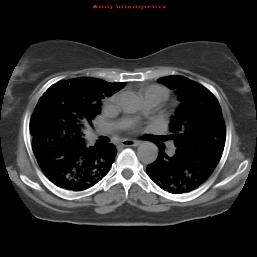Bronchoalveolar carcinoma (Radiopaedia 13224-13233 Axial non-contrast 23).jpg