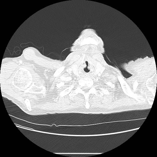 Bronchocele (Radiopaedia 17097-16795 Axial lung window 4).jpg