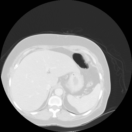 File:Bronchogenic carcinoma (Radiopaedia 73497-84262 Axial lung window 57).jpg