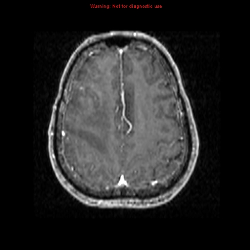 File:Bronchogenic carcinoma brain metastasis (Radiopaedia 9286-9969 Axial T1 C+ 18).jpg