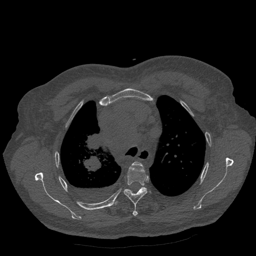 Bronchogenic carcinoma with metastatic lymphadenopathy (Radiopaedia 37671-39569 Axial bone window 15).jpg