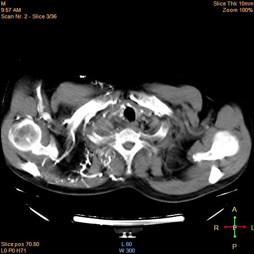 File:Bronchogenic carcinoma with superior vena caval invasion (Radiopaedia 22378-22406 Mediastinal window 1).jpg