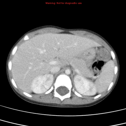 File:Bronchogenic cyst (Radiopaedia 9372-10063 C 28).jpg