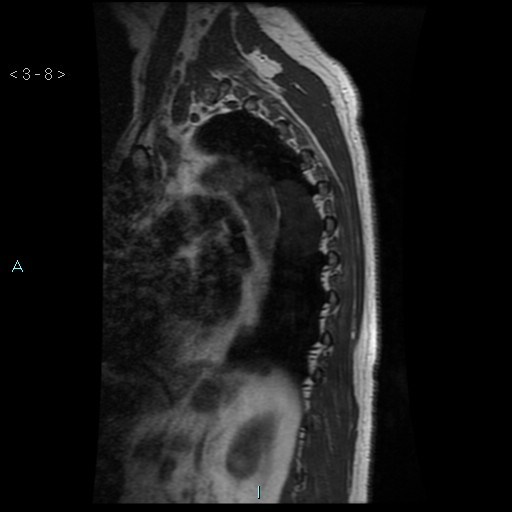 File:Bronchogenic cyst - posterior mediastinal (Radiopaedia 43885-47365 Sagittal T1 8).jpg