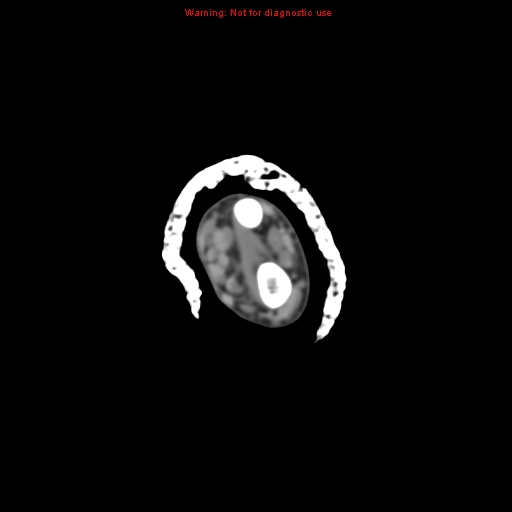 Brown tumor (Radiopaedia 12460-12694 Axial non-contrast 30).jpg
