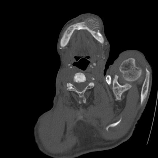 File:Brown tumor with secondary hyperparathyroidism (Radiopaedia 23591-23705 C 3).jpg