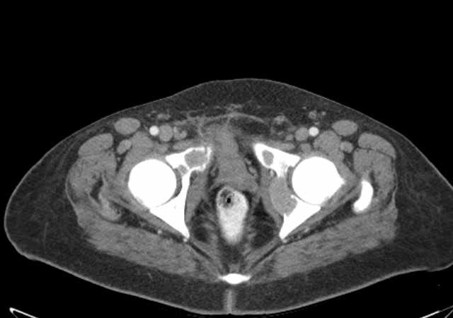 Brown tumors compressing the spinal cord (Radiopaedia 68442-77988 E 121).jpg