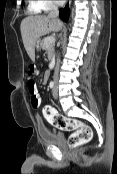 Brown tumors compressing the spinal cord (Radiopaedia 68442-77988 F 28).jpg