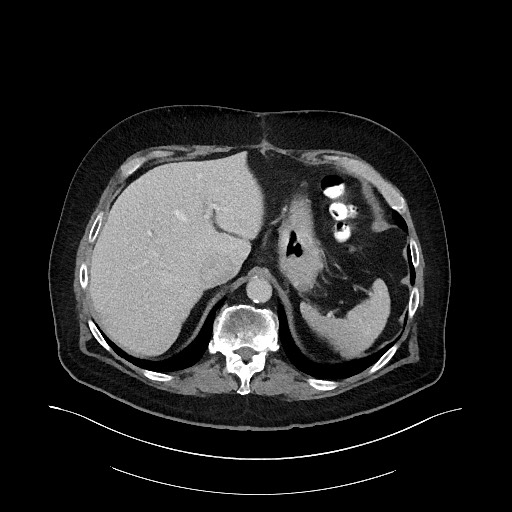 File:Buried bumper syndrome - gastrostomy tube (Radiopaedia 63843-72575 Axial 49).jpg