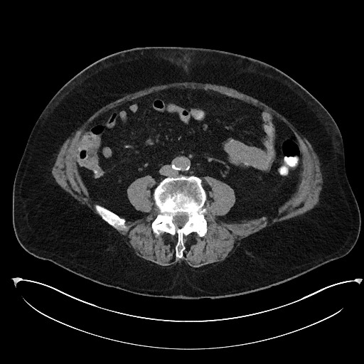 Buried bumper syndrome - gastrostomy tube (Radiopaedia 63843-72577 Axial Inject 73).jpg