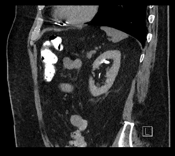 Buried bumper syndrome - gastrostomy tube (Radiopaedia 63843-72577 Sagittal Inject 34).jpg